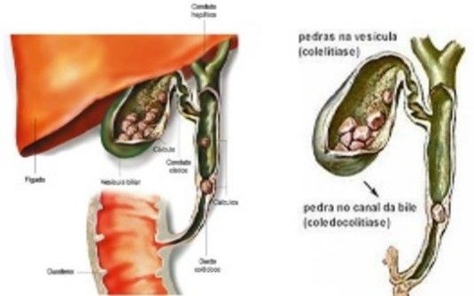 Cálculos de Vesícula