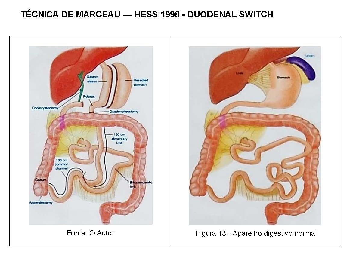 TÉCNICA DE MARCEAU — HESS 1998 - DUODENAL SWITCH