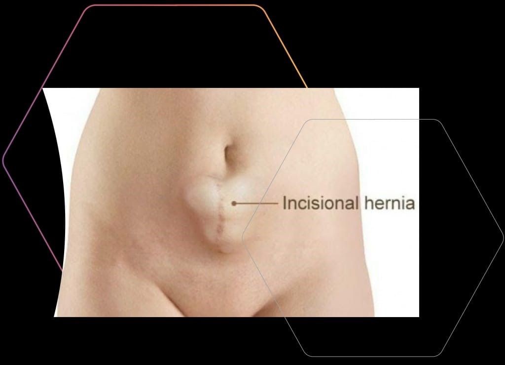 incisional hernia