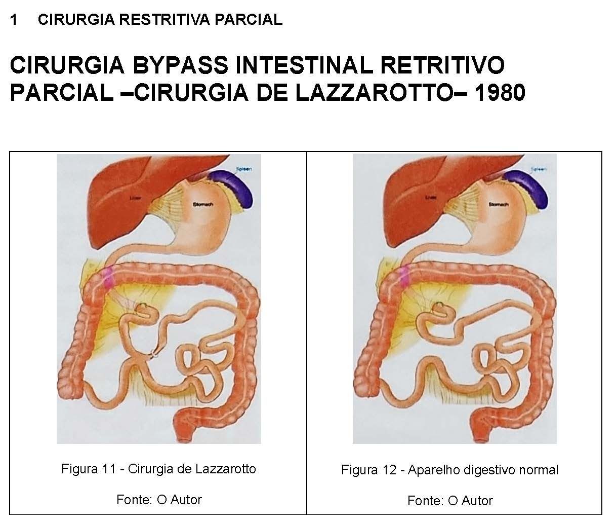 CIRURGIA BYPASS INTESTINAL RETRITIVO PARCIAL –CIRURGIA DE LAZZAROTTO– 1980